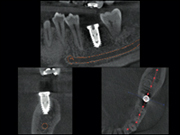 歯科用ＣＴでわかること