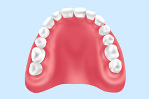 レジン床義歯（保険適用）