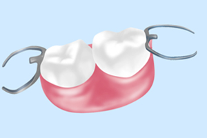 部分入れ歯（保険適用）