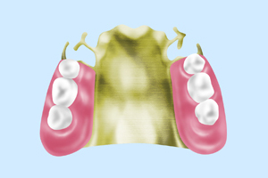 金属床義歯（自費）