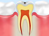 C0 初期虫歯
