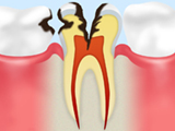 C3 歯髄に達した虫歯