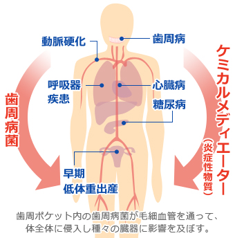 歯周病はお口の中だけの問題ではありません