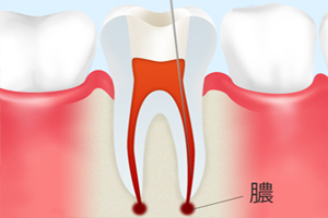 根管治療とは？